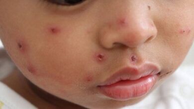 Boy Measles.jpg