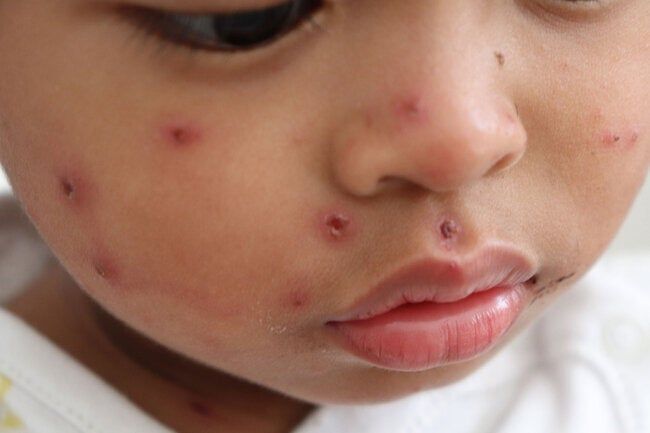 Boy Measles.jpg