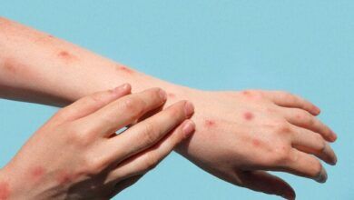 Mpox Rash.jpg