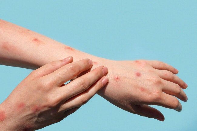 Mpox Rash.jpg