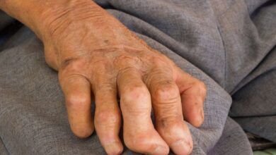 Left Hand Leprosy.jpg
