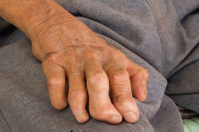 Left Hand Leprosy.jpg