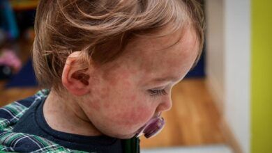 Measles 1500x993.jpg
