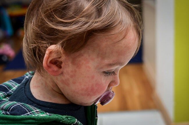 Measles 1500x993.jpg